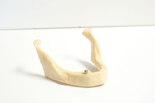 Quelle est la solution face à la résorption osseuse? - Francis Migneault d.d.