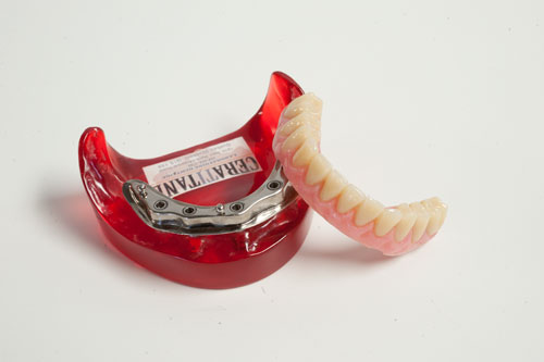 Quels sont les différents types de prothèses dentaires? - Francis Migneault d.d.