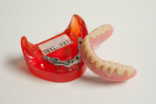 Quels sont les différents types de prothèses dentaires? - Francis Migneault d.d.