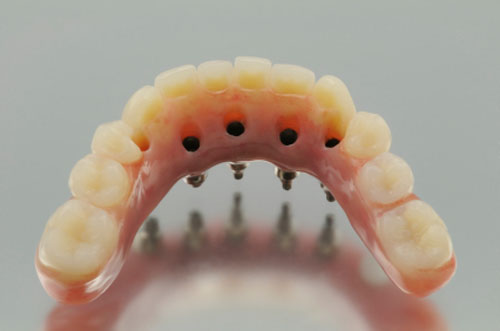 Quels sont les différents types de prothèses dentaires? - Francis Migneault d.d.