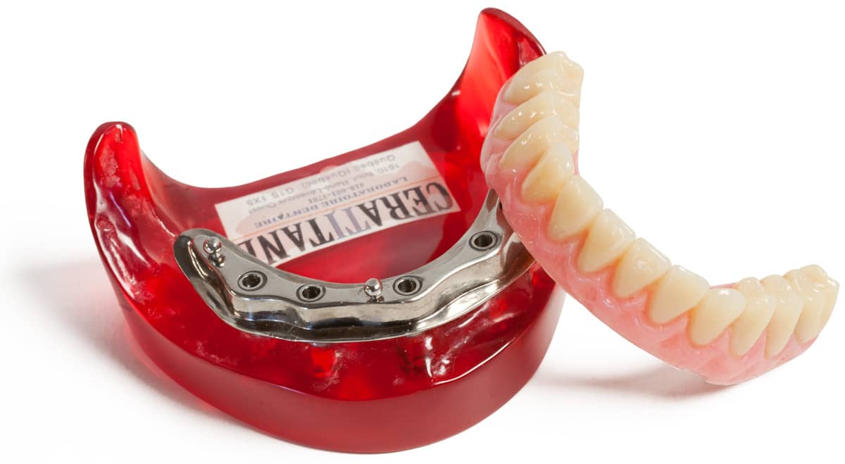 Prothèse dentaire sur implants