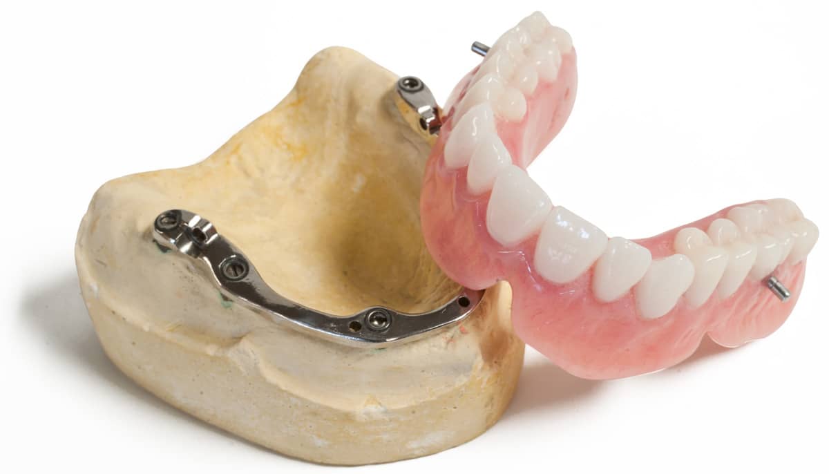 Prothèse dentaire sur implants